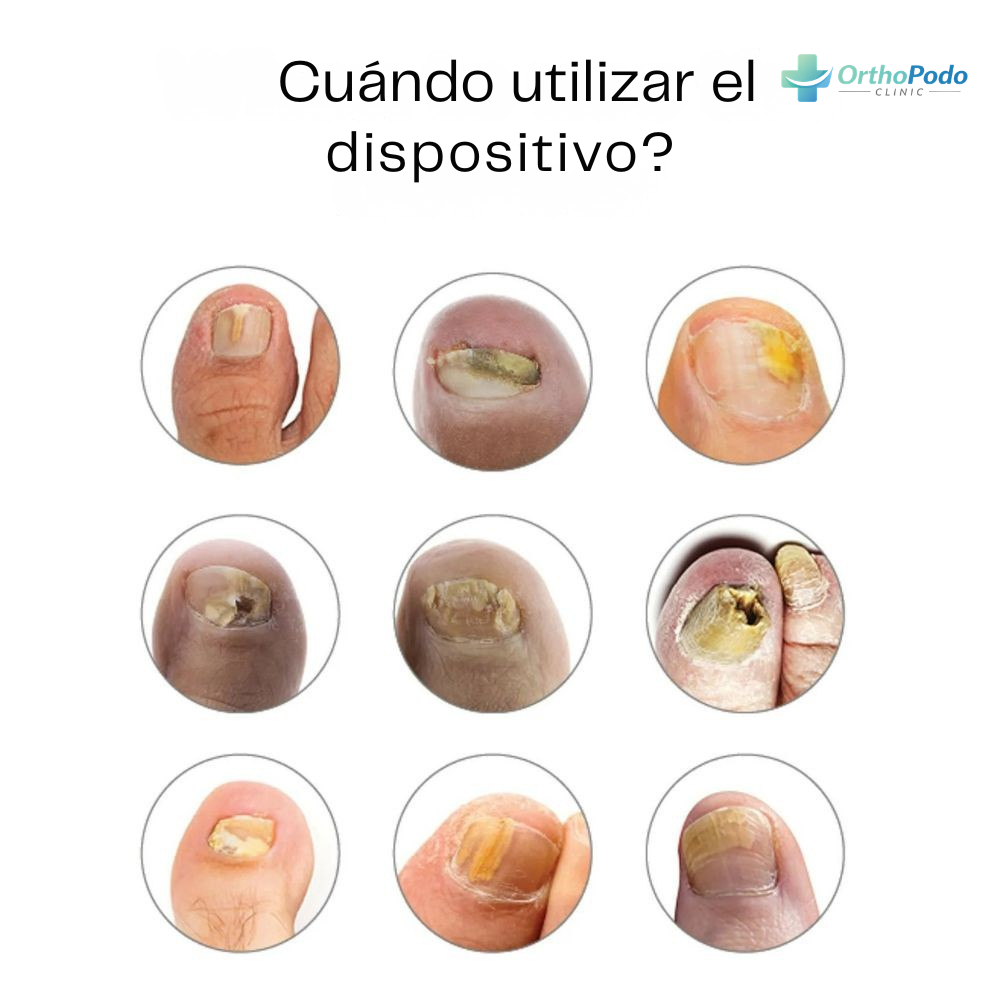 Dispositivo Terapia de Luz Azul OrthoPodo™